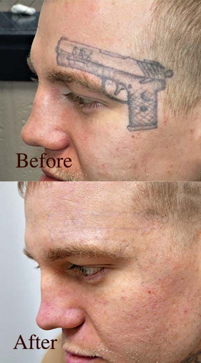 Laser Tattoo Removal | Indy Laser