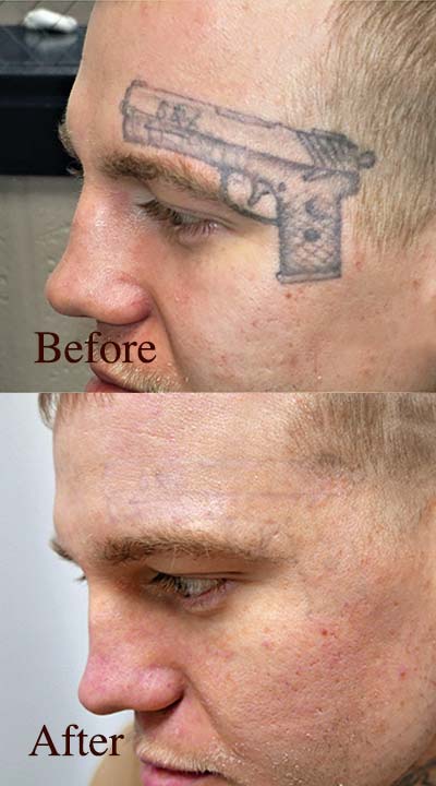 Before and after tattoo removal